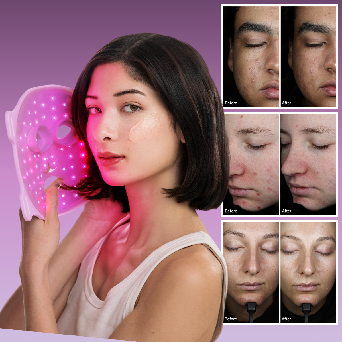 Exploring Pro-Approved Acne Care and The Latest Omnilux Clear Clinical Study Results