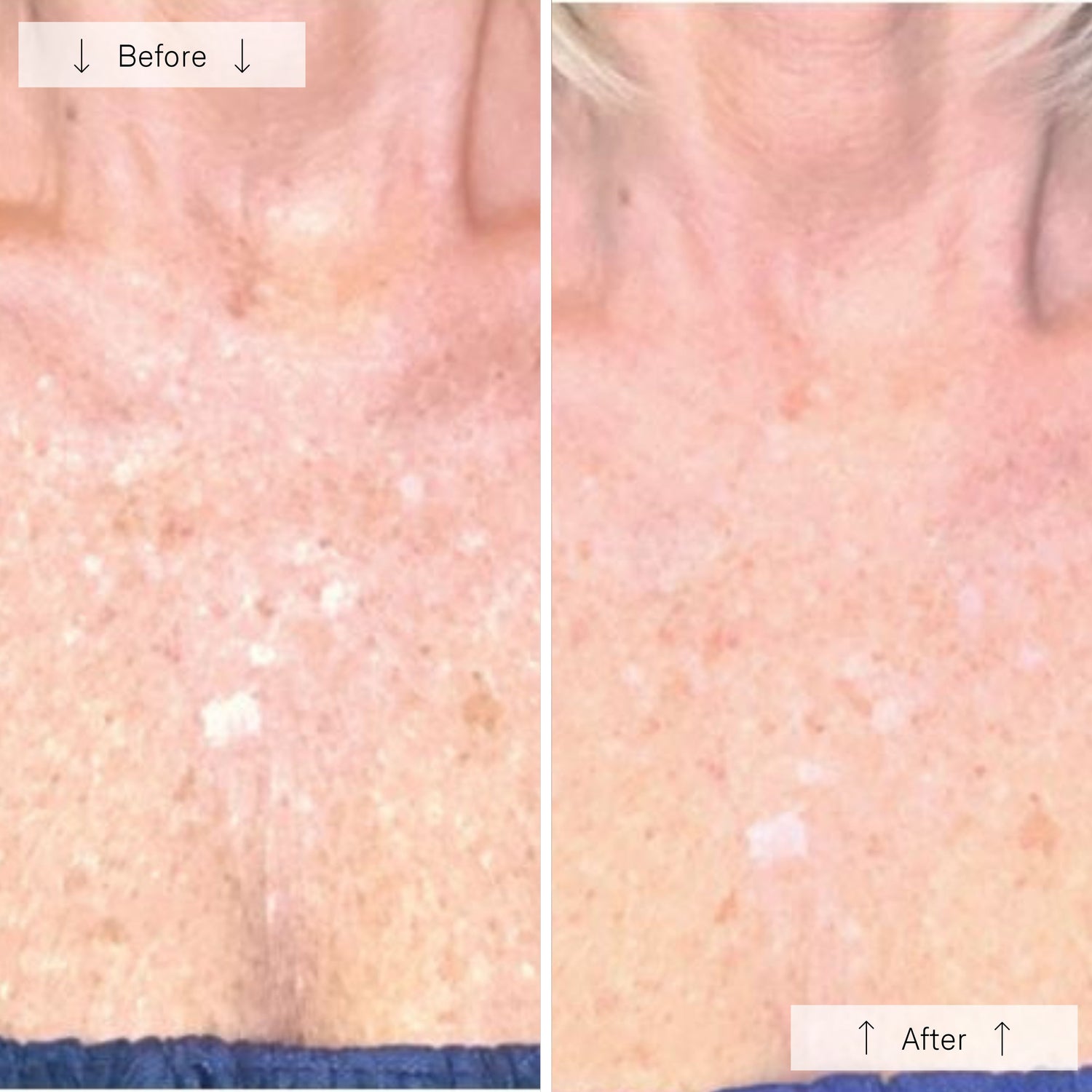 Omnilux Contour Neck & Décolleté