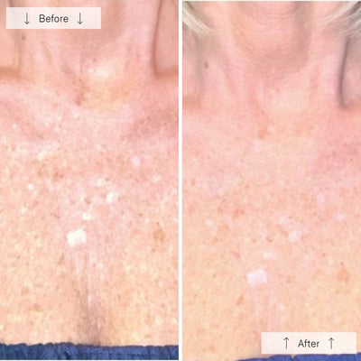 Omnilux Contour Neck & Décolleté